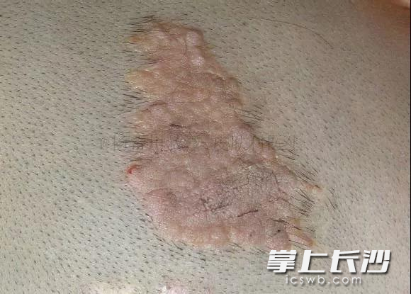 皮脂腺痣 皮脂腺痣