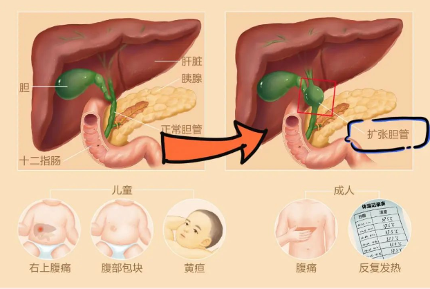 先天性胆总管囊肿又称胆管扩张症