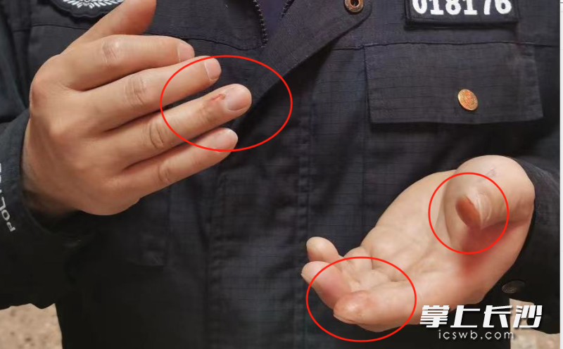 杨桂平的双手,曾多次在出警过程中受伤。长沙晚报通讯员 林鑫 供图 杨桂平的双手,曾多次在出警过程中受伤。长沙晚报通讯员 林鑫 供图