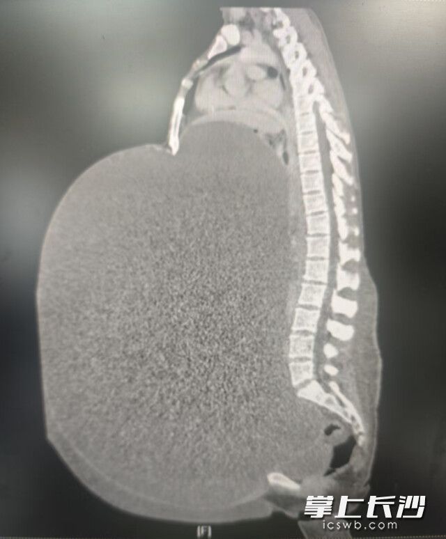 患者的CT检查结果提示为卵巢来源巨型肿瘤,肿块最大直径达50厘米。 患者的CT检查结果提示为卵巢来源巨型肿瘤,肿块最大直径达50厘米。